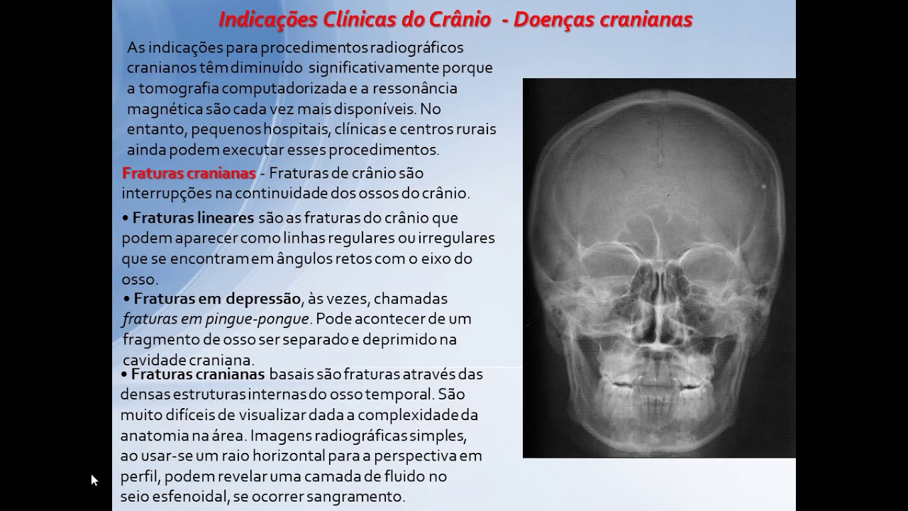 Posicionamento Radiol&oacute;gico &ndash; Cr&acirc;nioPA e Perfil