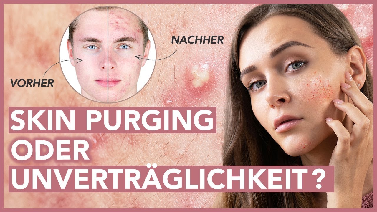 Skin Purging oder Erstverschlimmerung - So erkennst Du Unverträglichkeiten