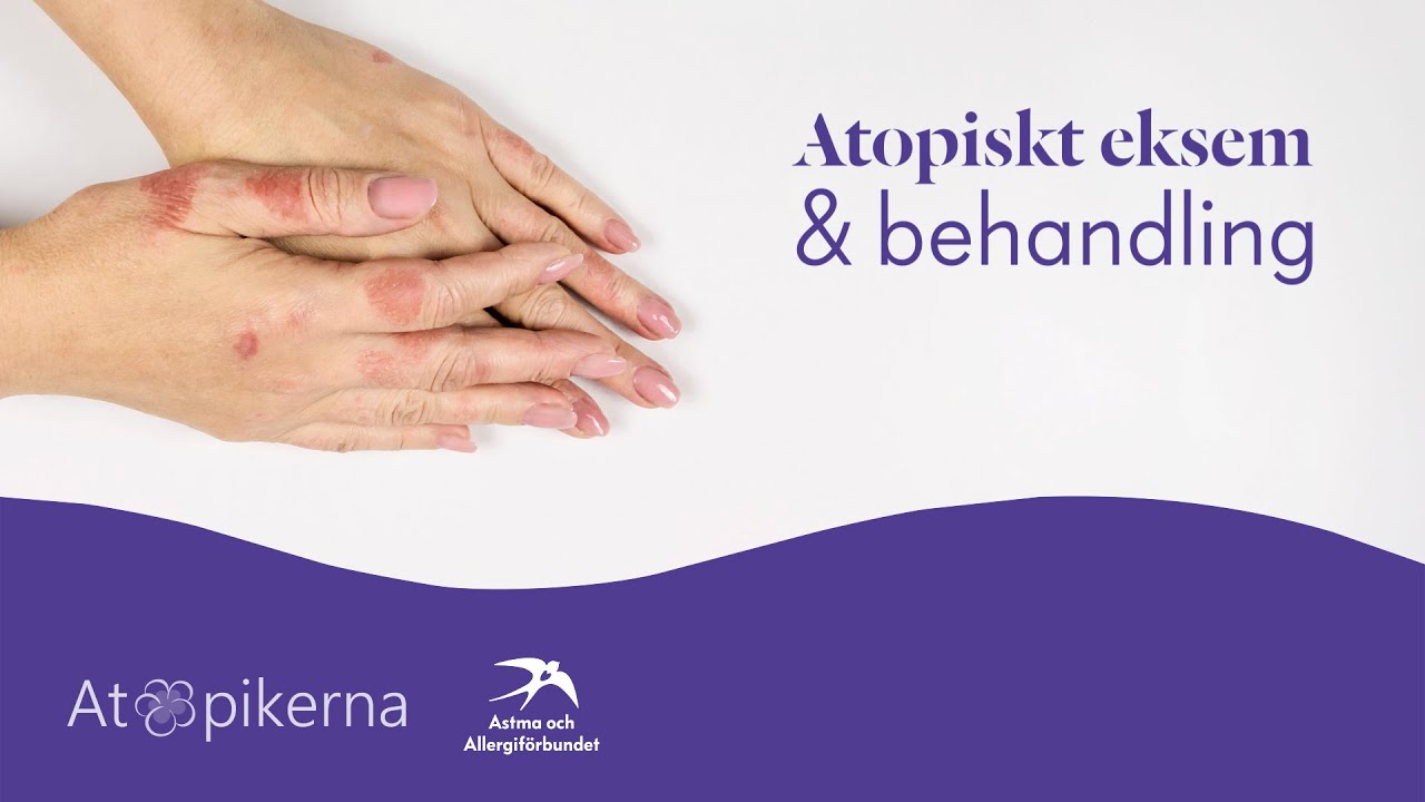 Atopiskt eksem och behandling