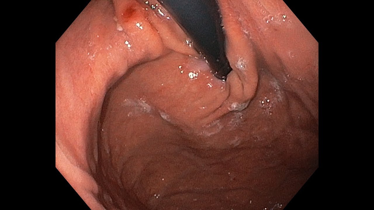 Fibroscopie gastrique