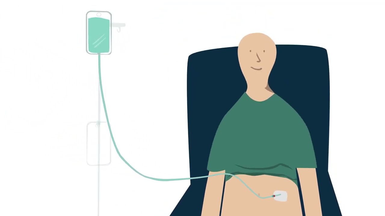 La Di&aacute;lisis Peritoneal | &iquest;Qu&eacute; es la DPCA?