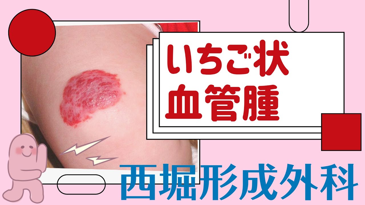 【西堀形成外科】赤あざ_いちご状血管腫について