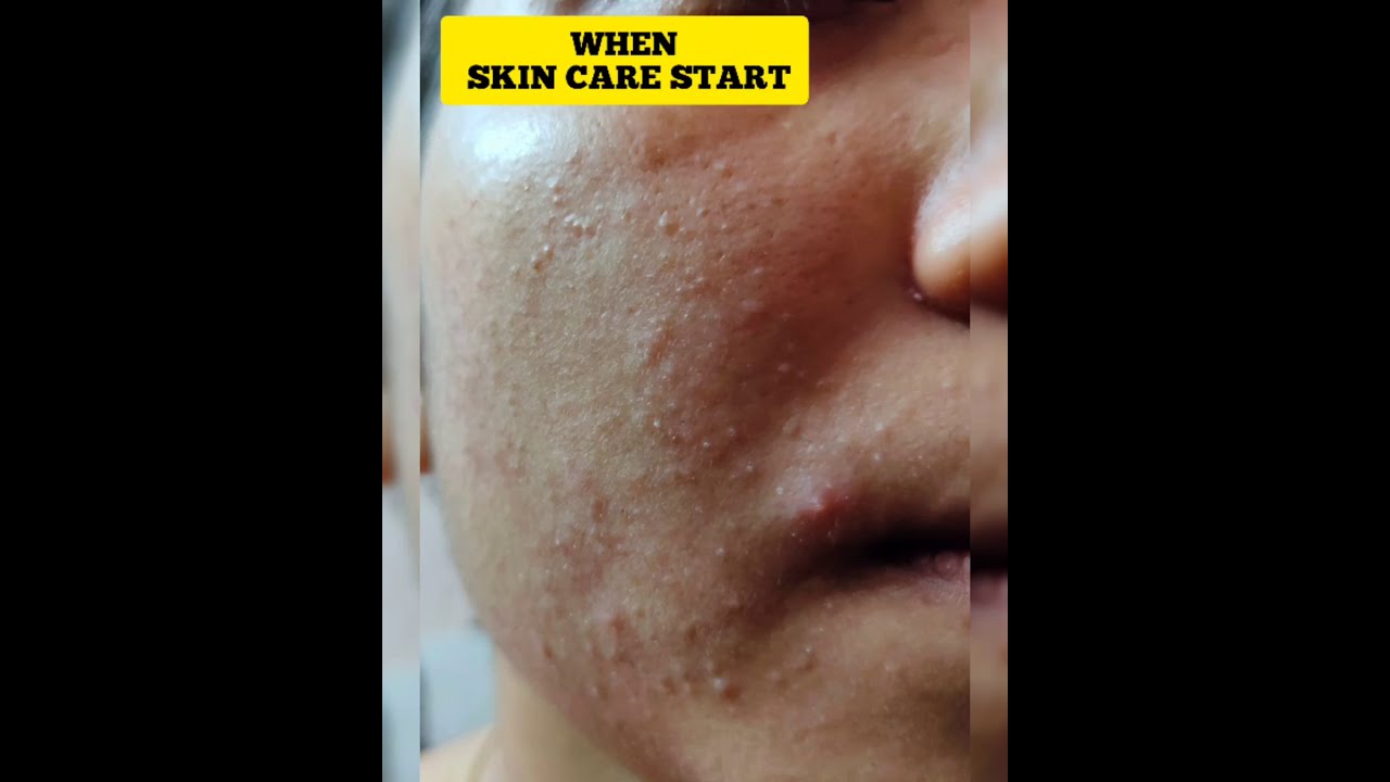 MY TINY BUMPS/MASK ACNE JOURNEY|SHORTS #shorts