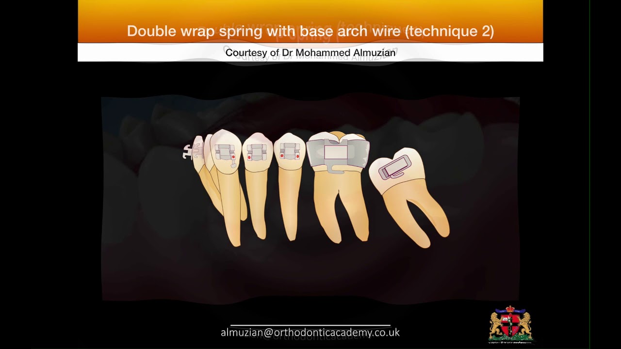 Uprighting impacted molars