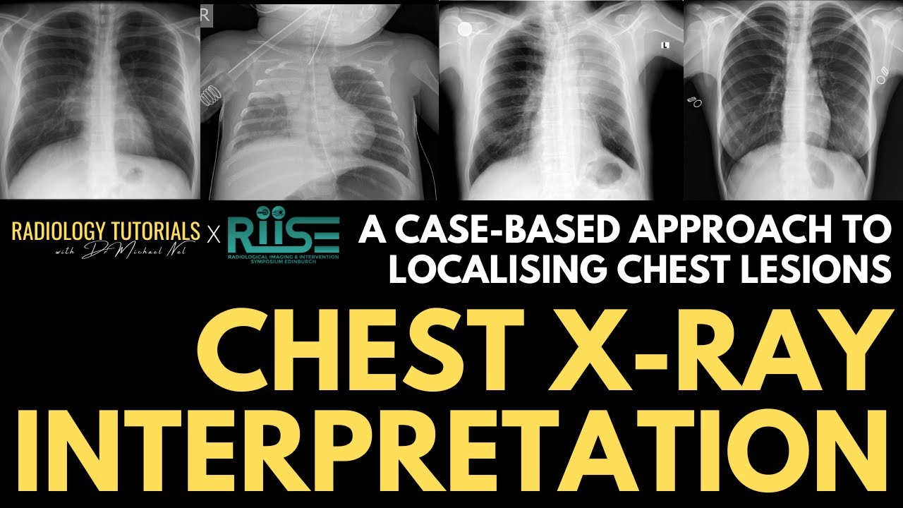 Localising Lesions on Chest Radiographs | A Case-Based Approach | RIISE Workshop