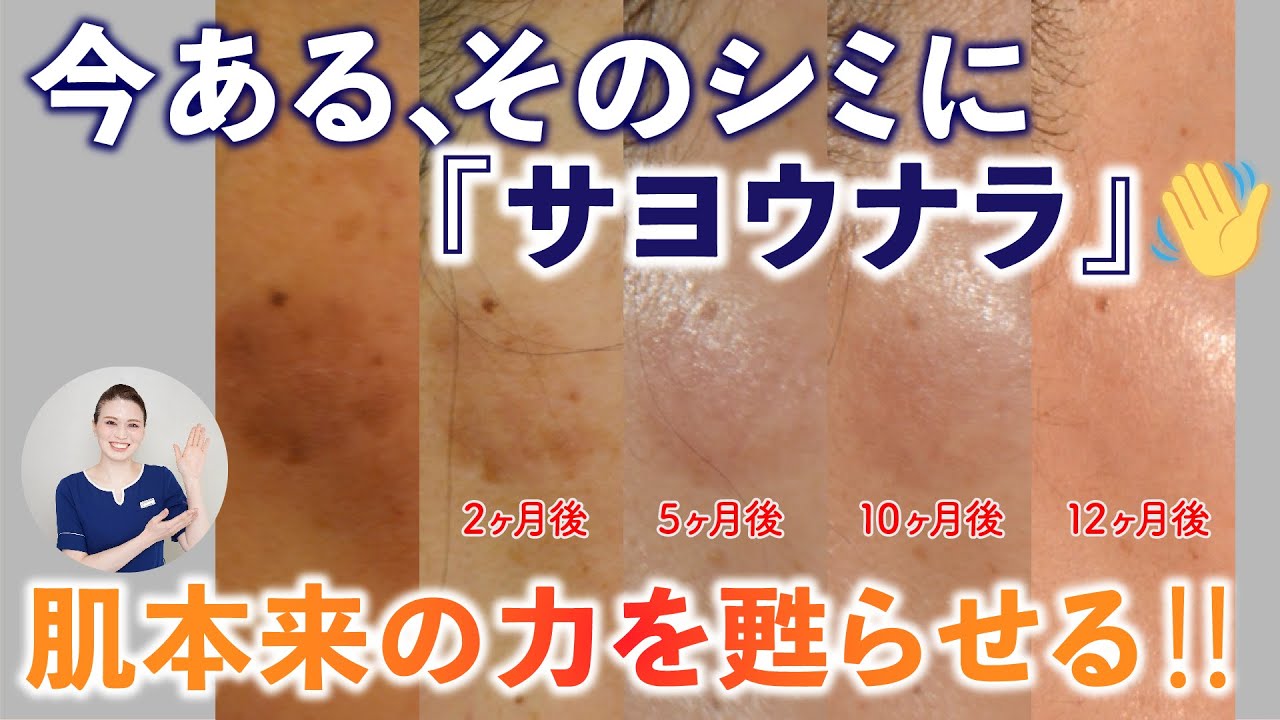 VOL.36【ここまでキレイになる、シミの改善症例】お客様の改善症例公開