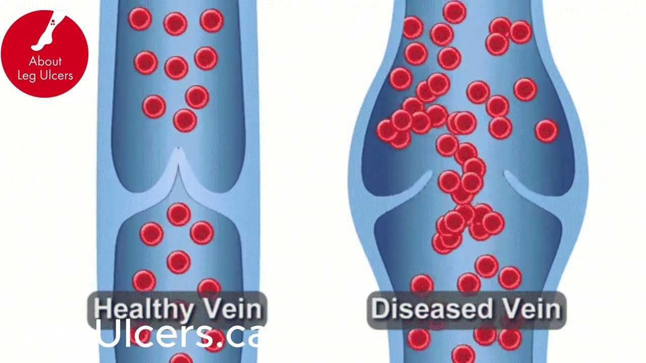 How to heal Your Venous Leg Ulcers Using Compression!
