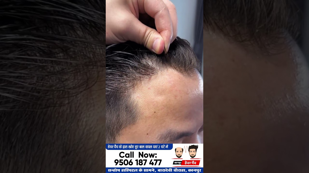 Hair Patch Service in Kanpur | Hair Patch Centre for Men in Kanpur | Kanpur Hair Patch | 𝟗𝟓𝟎𝟔𝟏𝟖𝟕𝟒𝟕𝟕