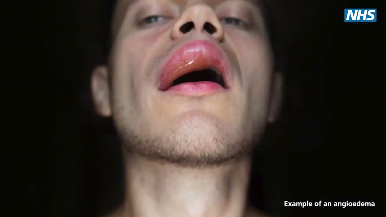 Hereditary angioedema - web version