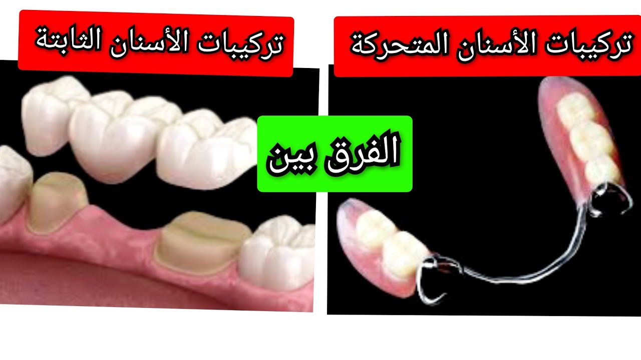 الفرق بين تركيبات الأسنان الثابتة ( التلبيسة)  و تركيبات الأسنان المتحركة و أنواعهم المختلفة