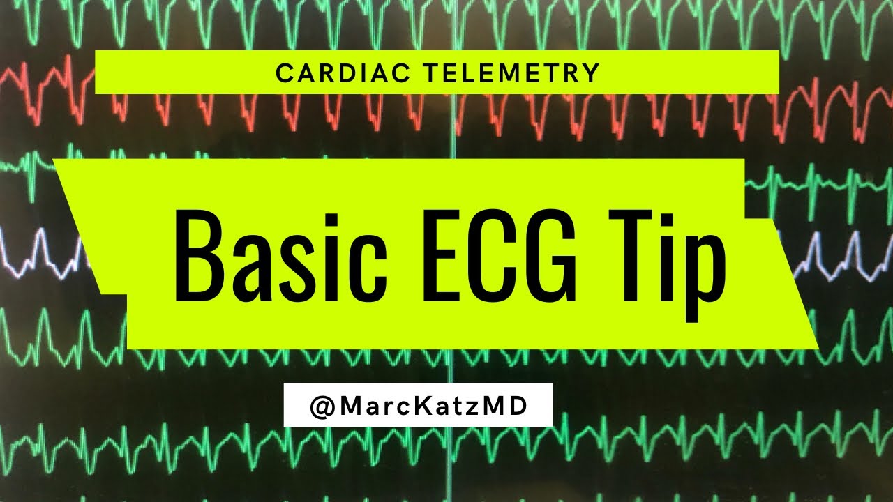 Basic ECG Tip: guess this cardiac telemetry diagnosis