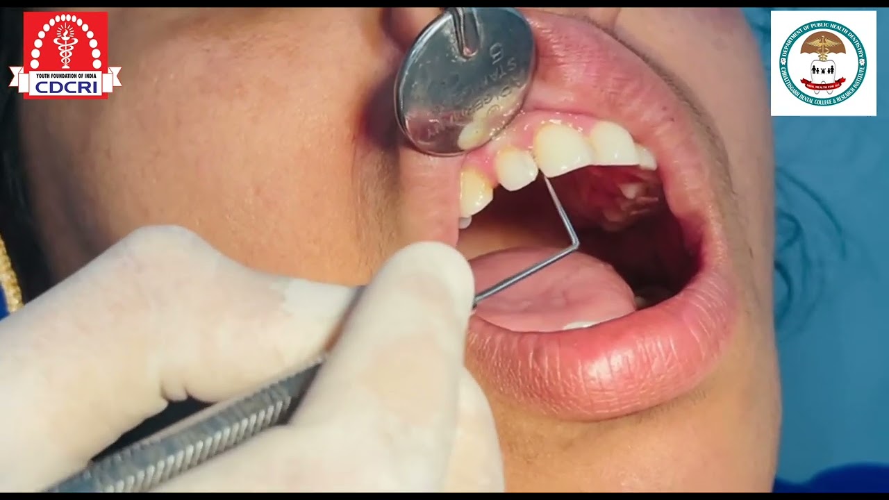 GINGIVAL INDEX