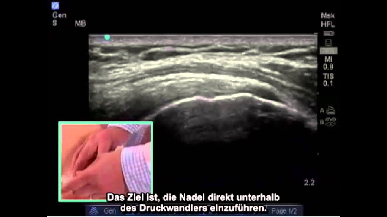 Anleitung: Ultraschallgeführte Schulterinjektion