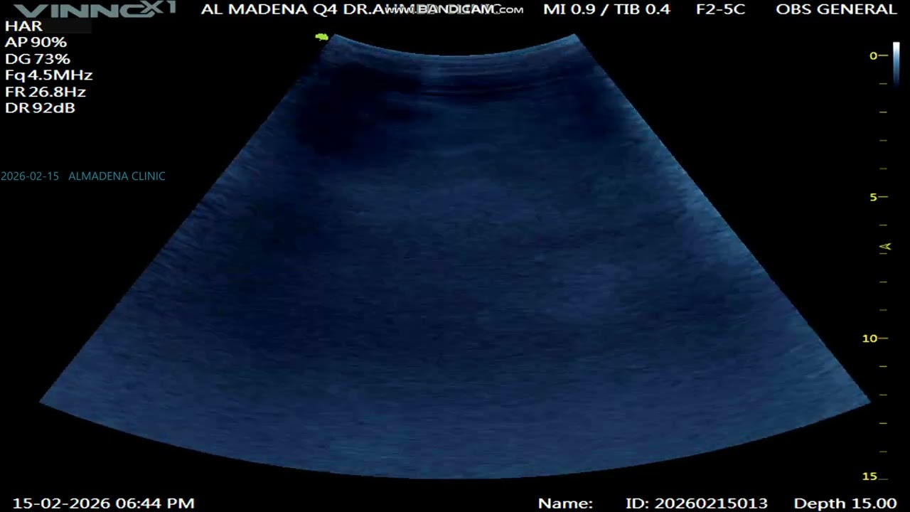 ABDOMEN : RK RENAL STONE  2026 02 15 18 41