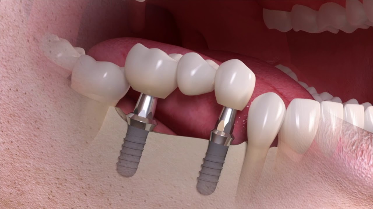 🦷Fogászati implantátum választása esetén érdemes hosszútávon gondolkodni.
