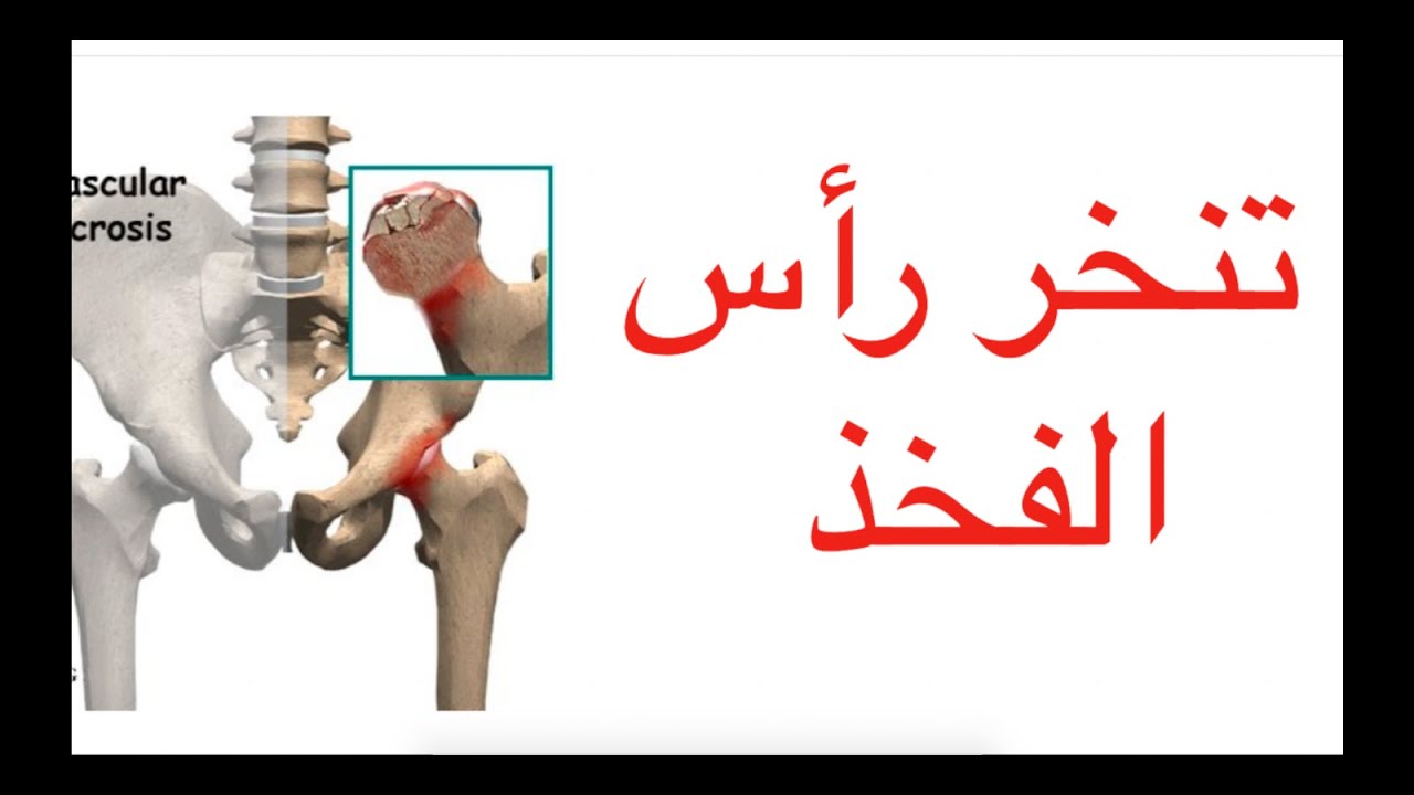 Osteonecrosis / تنخر  رأس الفخذ و هل يؤدي الى خشونة الورك؟