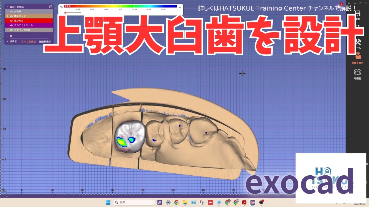 #317 exocad設計　上顎大臼歯を設計！（解説なし版）