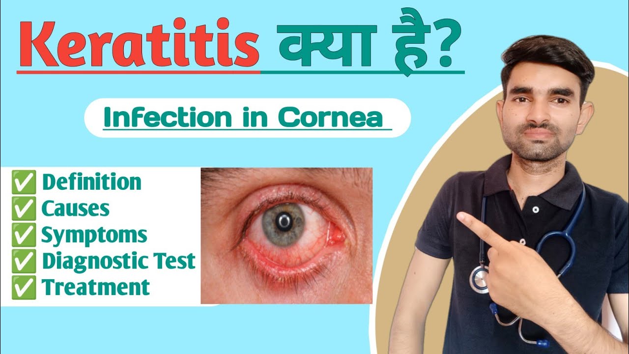 Keratitis Lecture in Hindi | Causes, Symptoms and Treatment of Keratitis