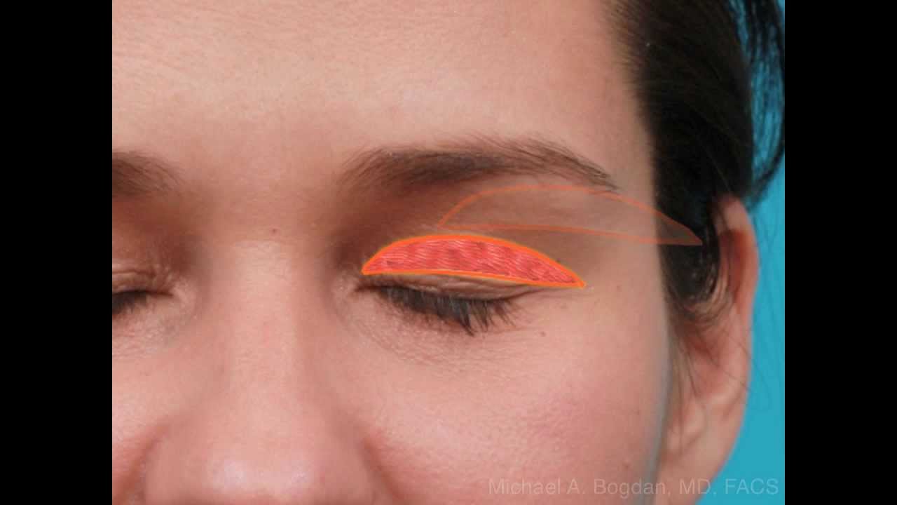 Upper Eyelid Surgery in Dallas by Dr. Michael Bogdan