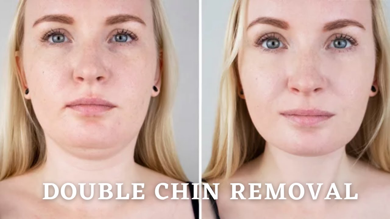 Kybella Double Chin Removal | How To Dissolve Stubborn Fat