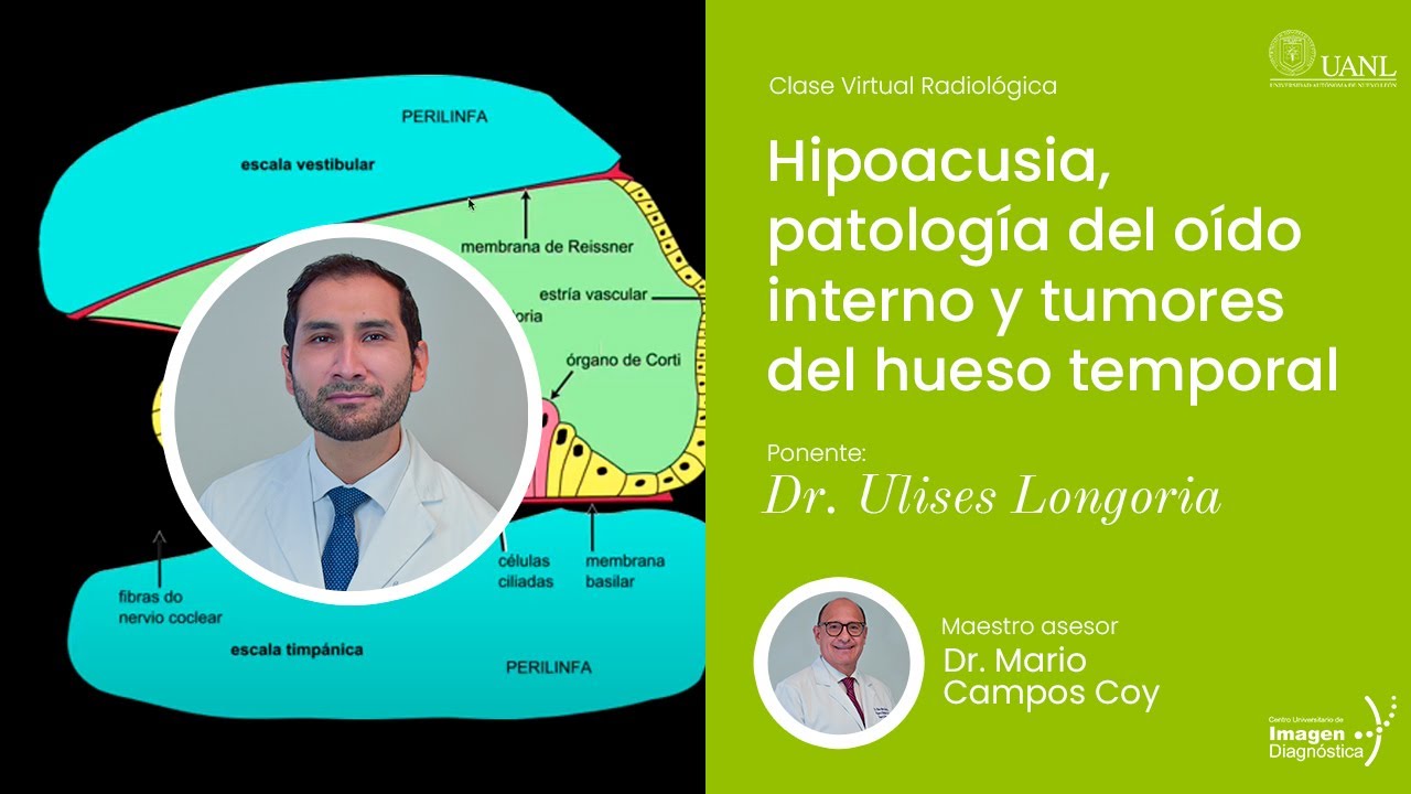 Hipoacusia, patología del oído interno y tumores del hueso temporal por Dr. Ulises Longoria Estrada