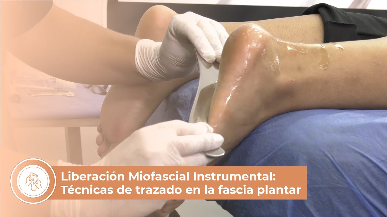 Liberación Miofascial Instrumental: Técnicas de trazado en la fascia plantar
