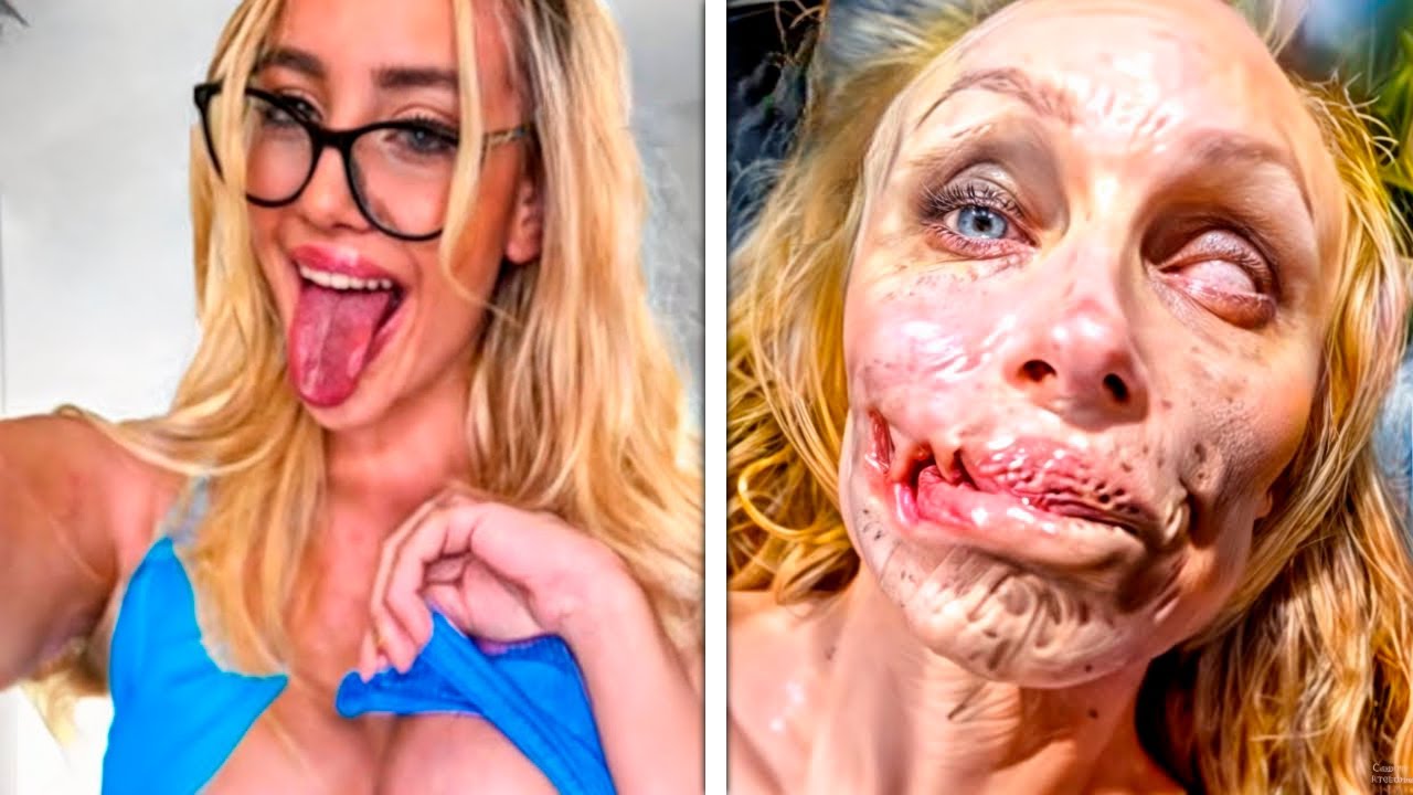 11 DESASTRES EM CIRURGIAS PLÁSTICAS EXTREMAS