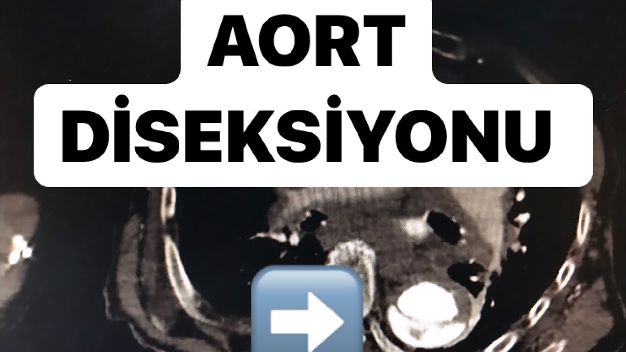 AORT DİSEKSİYONU ACİL SERVİS YÖNETİMİ,TANI VE TEDAVİSİ