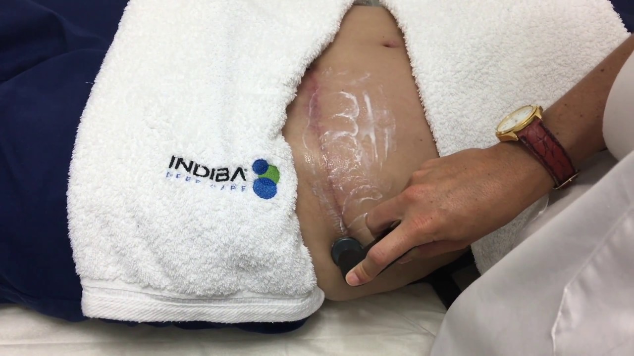 INDIBA TRAS ABDOMINOPLASTIA