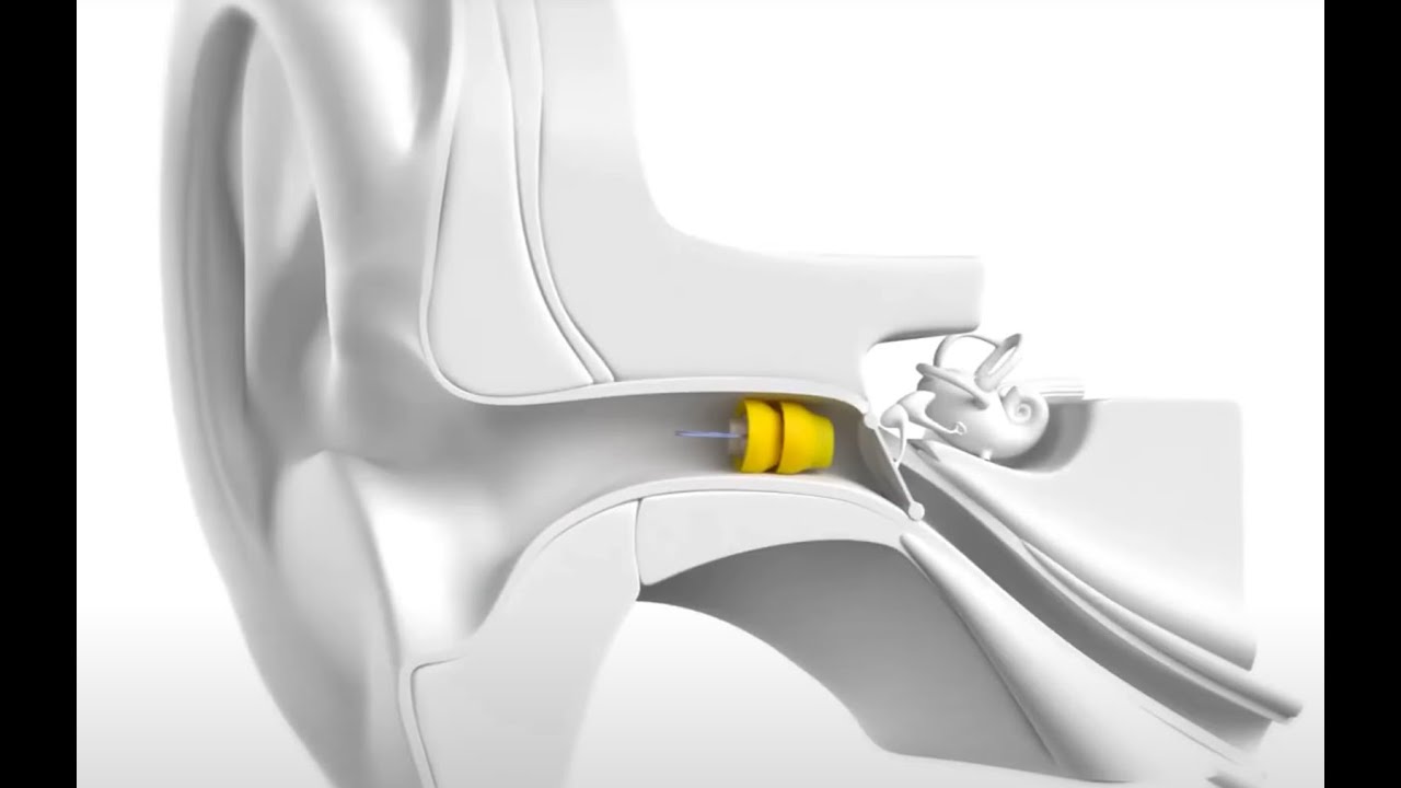 Phonak Lyric The 24 7 Invisible Hearing Aid Available at Holistic Hearing Solutions
