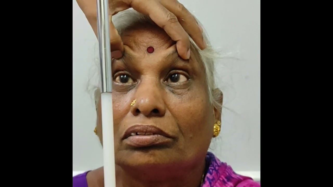 Lateral rectus palsy in eye