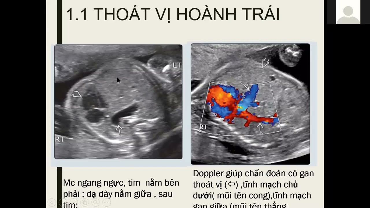 14 Hướng tiếp cận bệnh lý lồng ngực - BS Nguyễn Xuân Lan