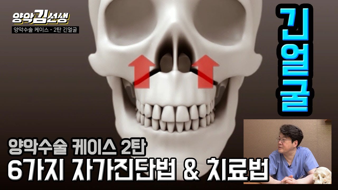 양악수술 케이스 2탄 '긴얼굴' 성형,양악수술? 해결 방법은!?