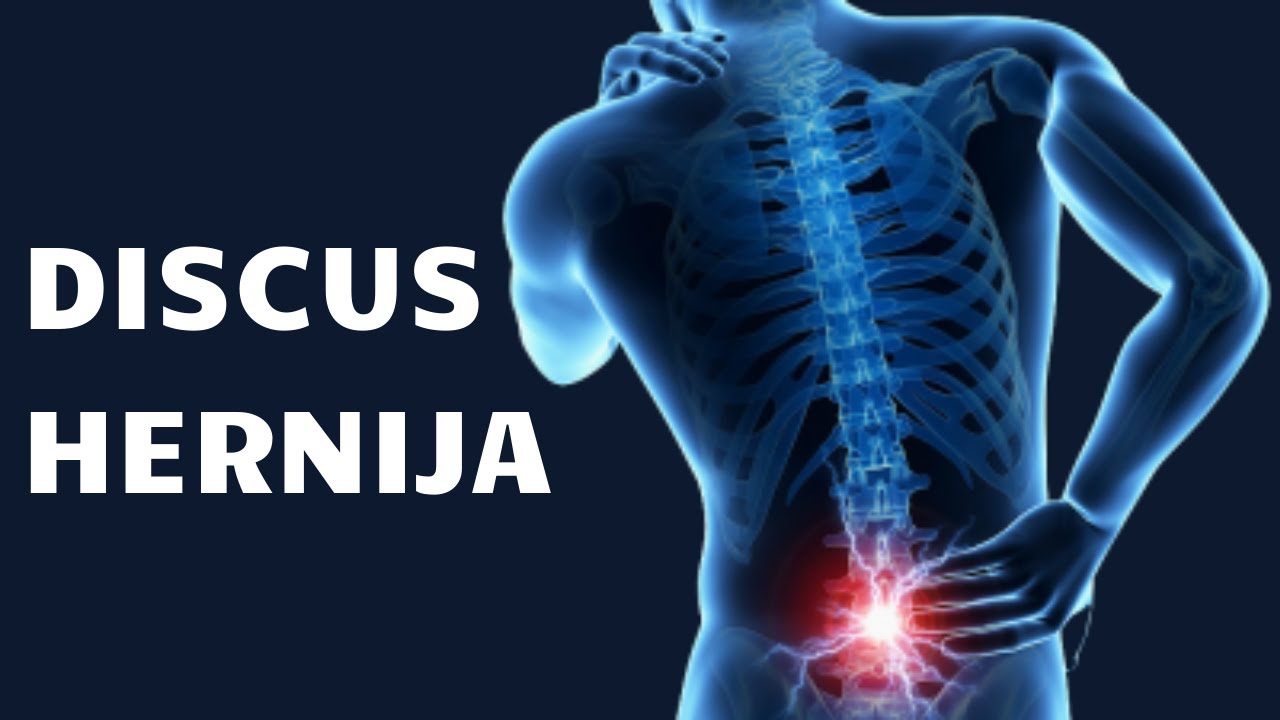 NAJBOLJE VEŽBE ZA DISKUS HERNIJU