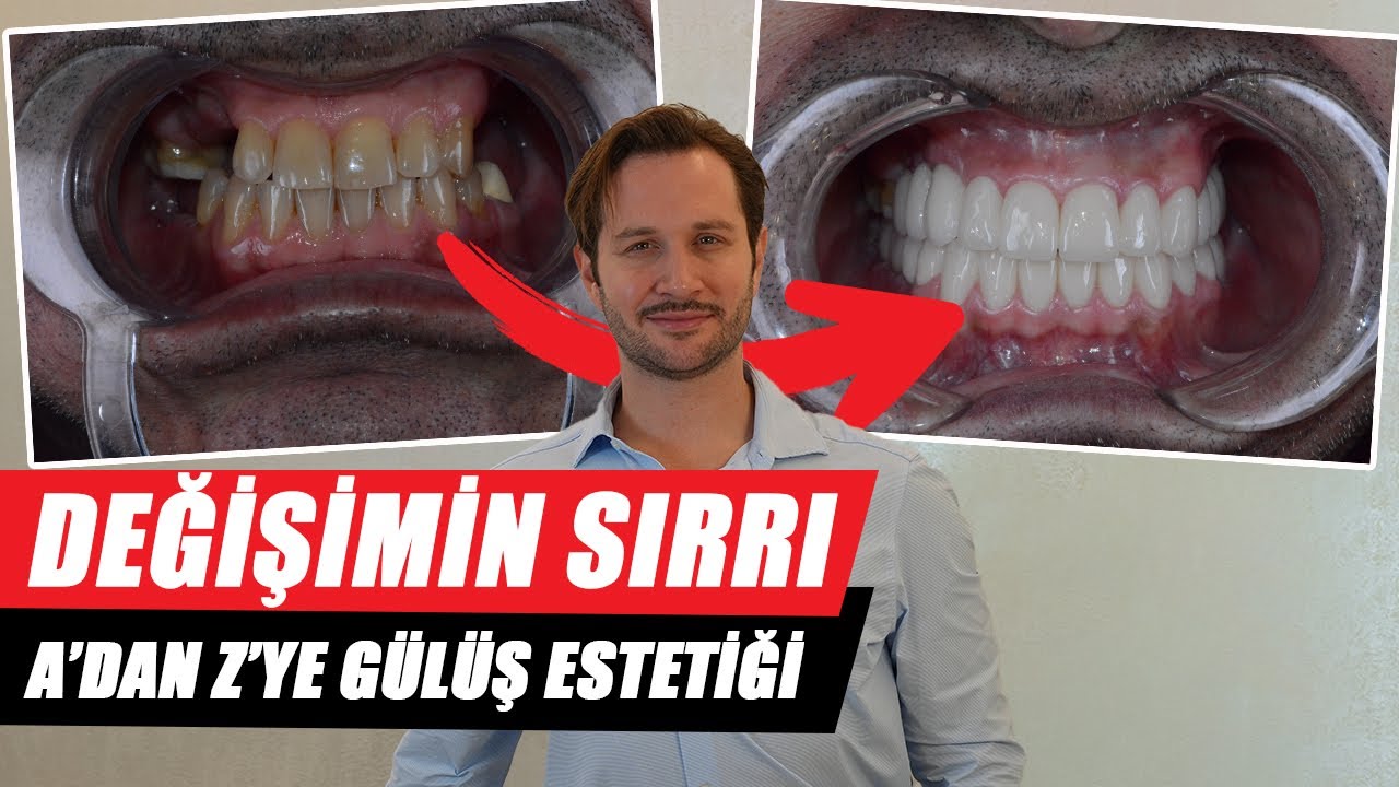 Gülüş Estetiği - Hollywood Smile | Smile Design | : Yeni Bir Gülümsemeye Hazır mısınız?
