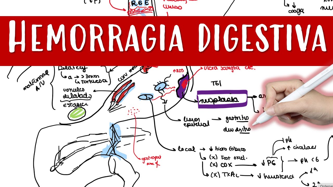 Hemorragia Digestiva Alta #hda #varices #ulcera