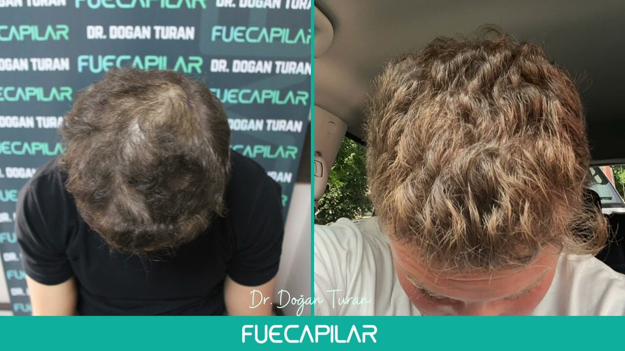 DHI Hair Transplant (2430 Grafts Diffuse Thinning) by Dr Turan - FUECAPILAR, Istanbul, Turkey