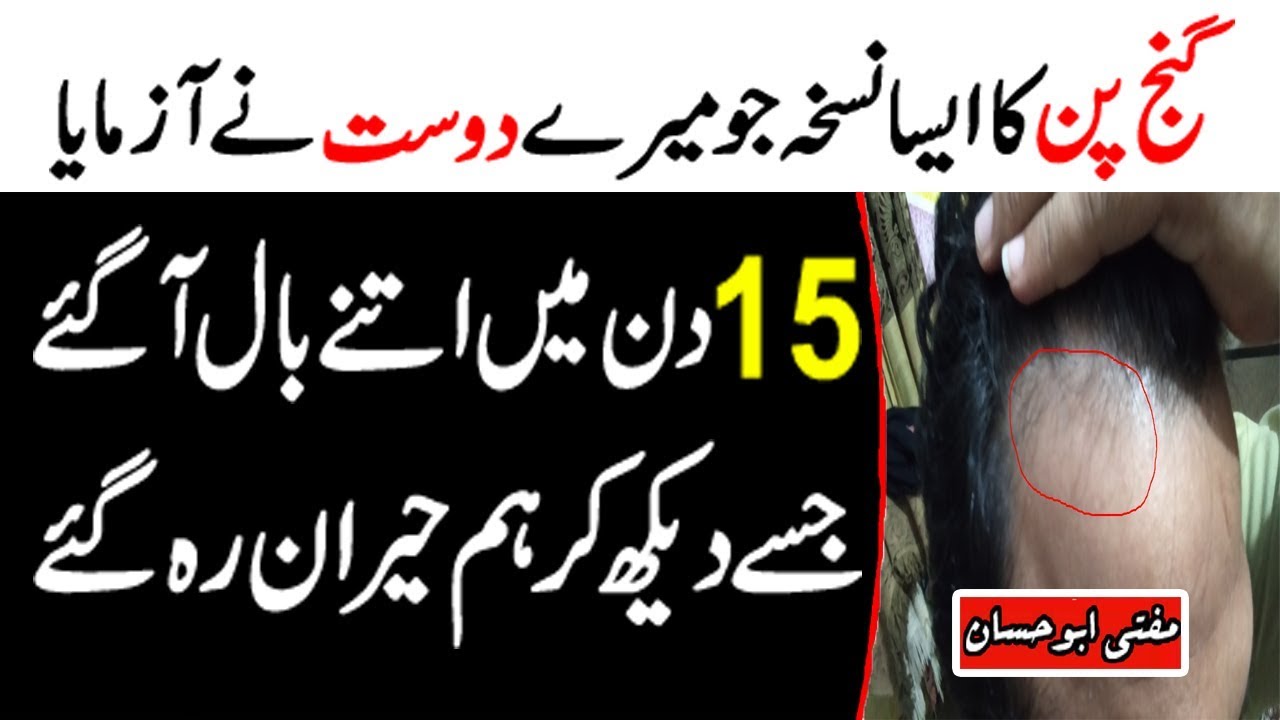 Sirf 15 Din Mein Ganjpan Ka Azmoda ilaj - Fast Bald Hair Growth using Castor Oil