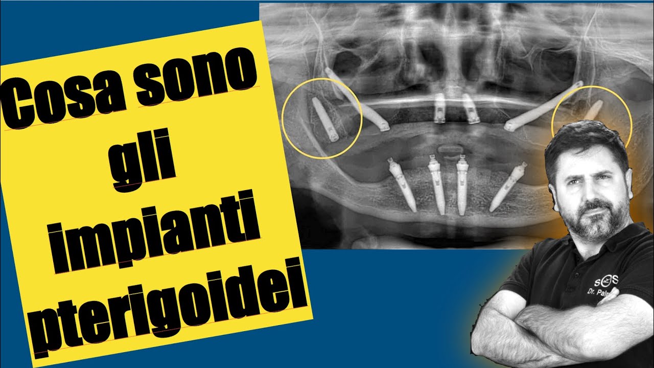 Impianti pterigoidei una soluzione in più per chi ha poco osso.