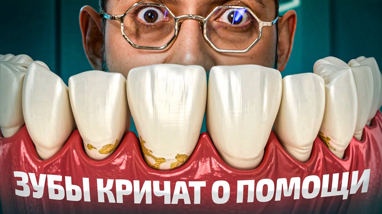 Зубы с виду здоровые, НО нет! Все, что нужно знать о КЛИНОВИДНЫХ дефектах