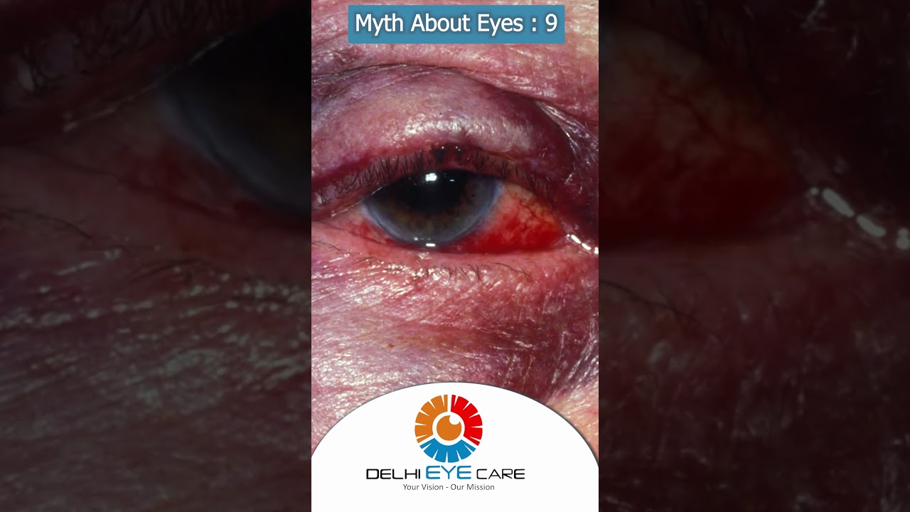 Myth 9: An Eye Injury Isn&rsquo;t Serious if There&rsquo;s No Pain ? #eyefacts #eyecare #delhieyecare