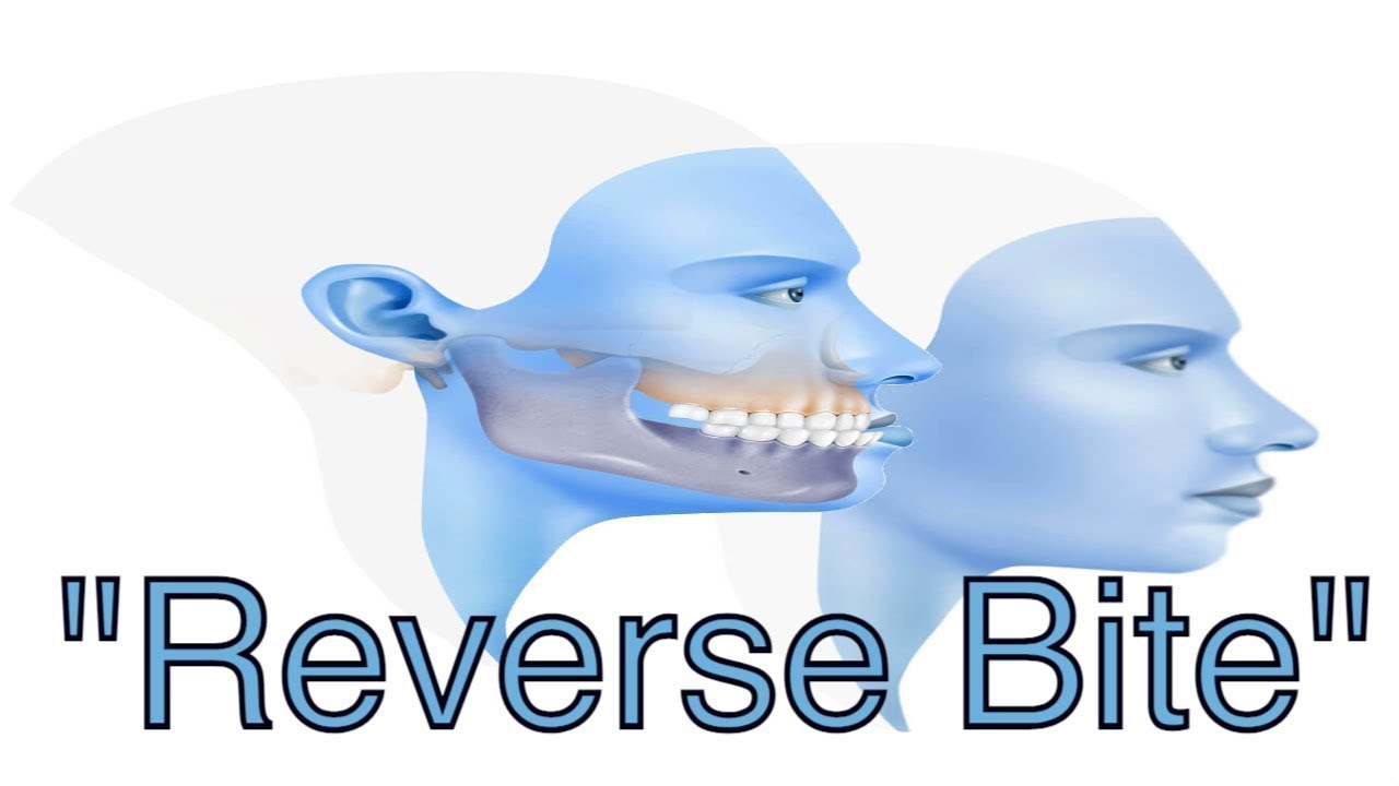 Underbite correction (Aka: Reverse Overjet / Reverse Overbite / Skeletal 3 Malocclusion)