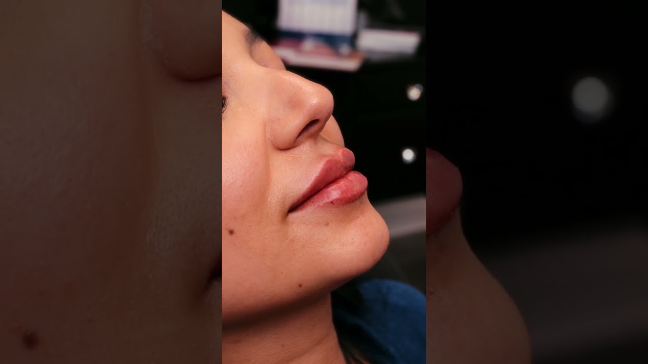 Expert Lip Filler Application for Natural-Looking Results #aesthetics