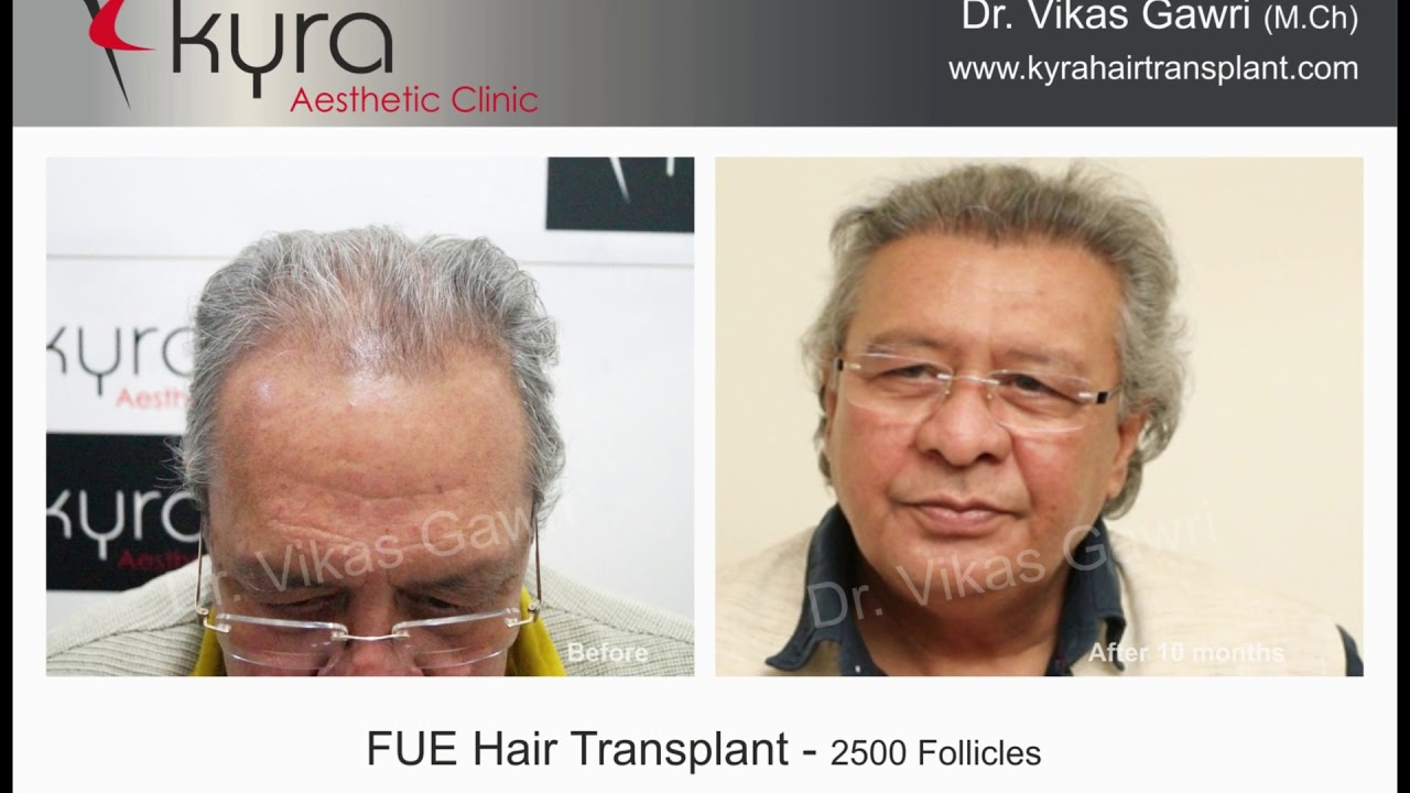 Actor Abhijit Lahiri's Hair Transplant -  Kyra Hair Transplant Ludhiana
