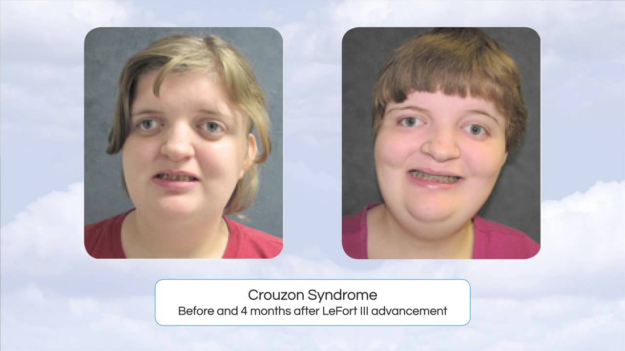 Craniofacial Syndromes, Dr. Pat Ricalde