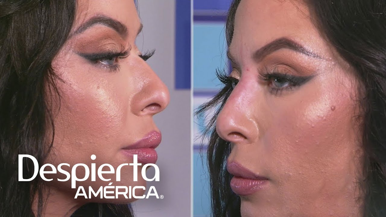 Rinoplastía sin cirugía: todo sobre este nuevo método instantáneo | Dr. Juan