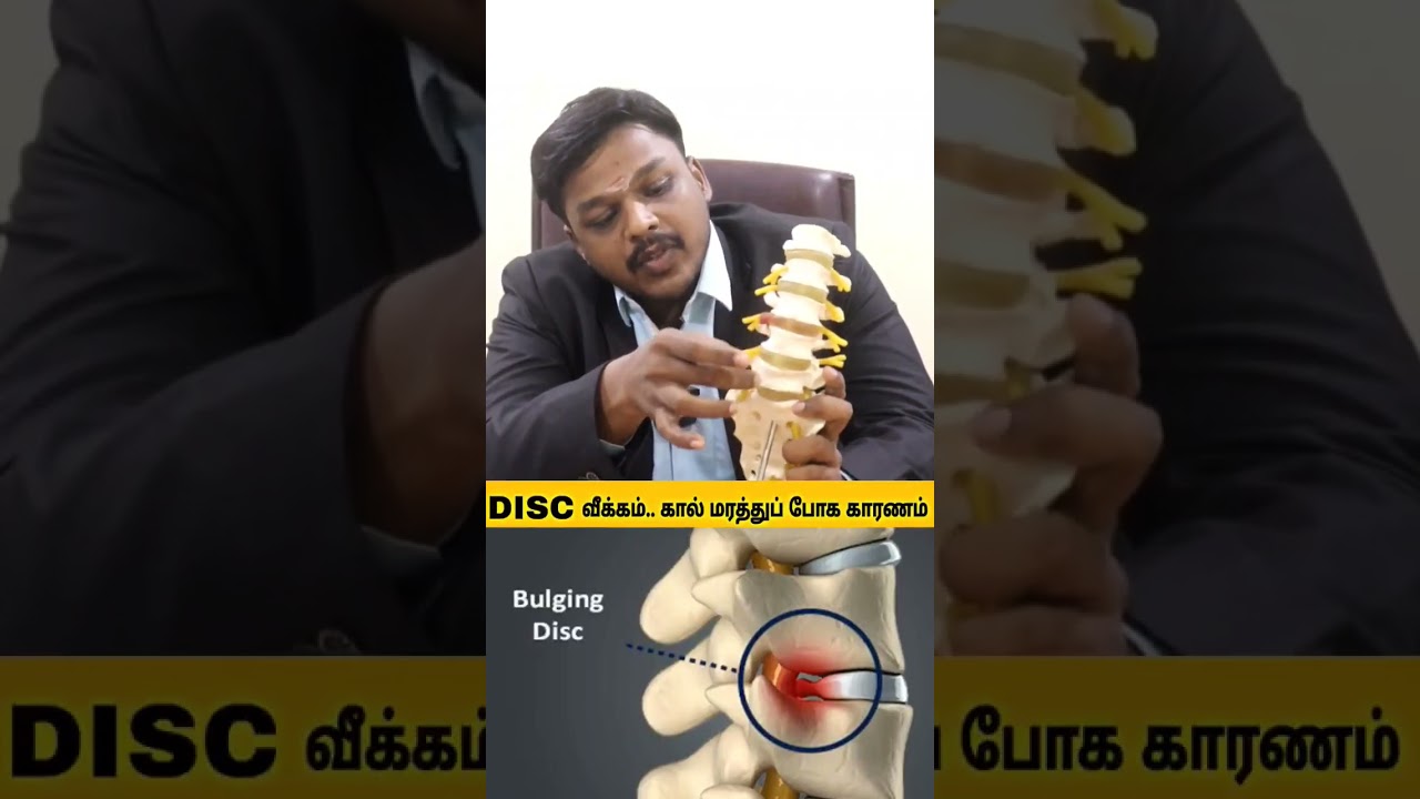 Disc வீக்கம்... முதுகு வலி இருந்தால்😰 இதுவே கால் மரத்து போக ஒரு காரணம்... #orthopedics #backpain