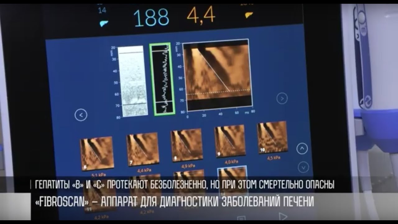FibroScan в РКБ: современная диагностика