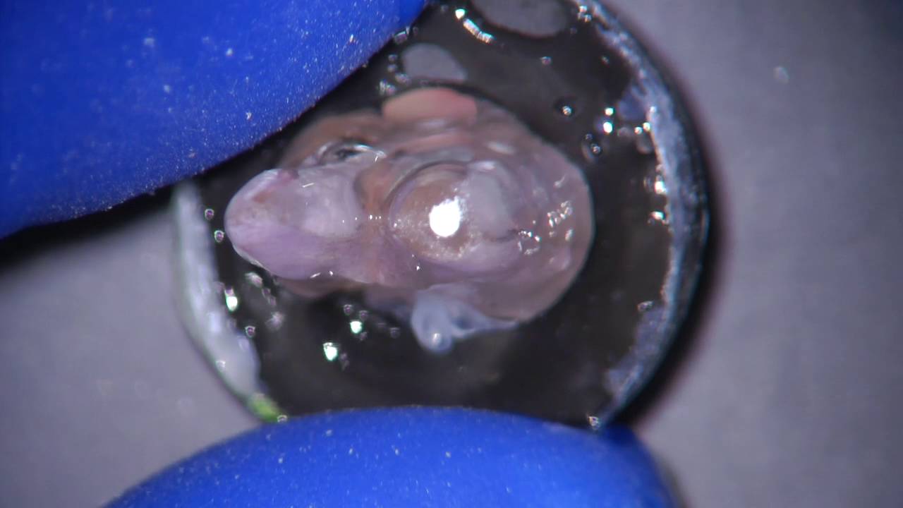 apical plug