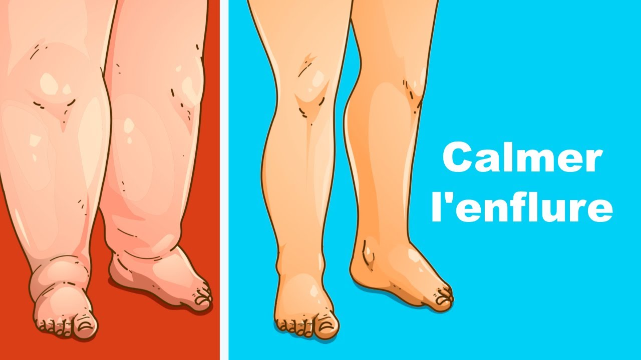 Lymphoedème : conseils efficaces pour calmer l'enflure